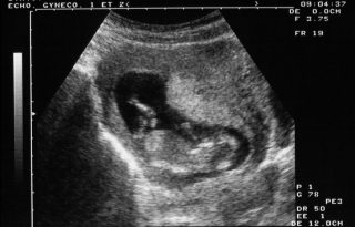 Elfogadták Amerika legszigorúbb abortusztörvényét
