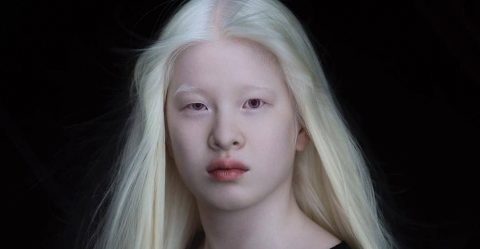 albinizmus-modell-xueli-abbing