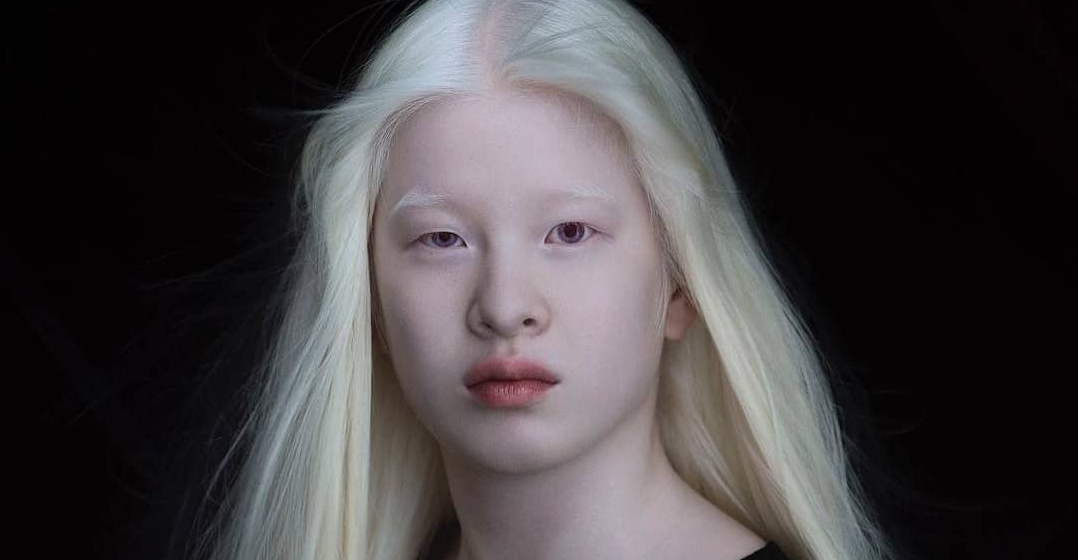 albínó emberek látása