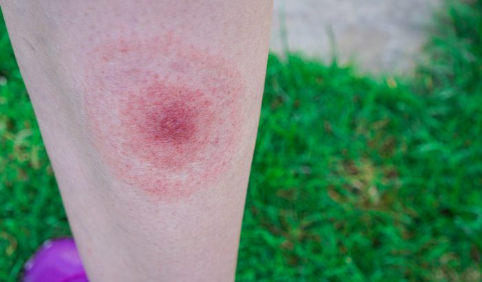 A Lyme-kór 5 tünete: erre figyelj, ha megcsípett egy kullancs!