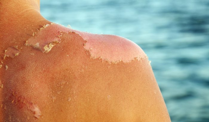 5 módszer, hogy biztonságosan kezeld a hámló bőröd napégés után