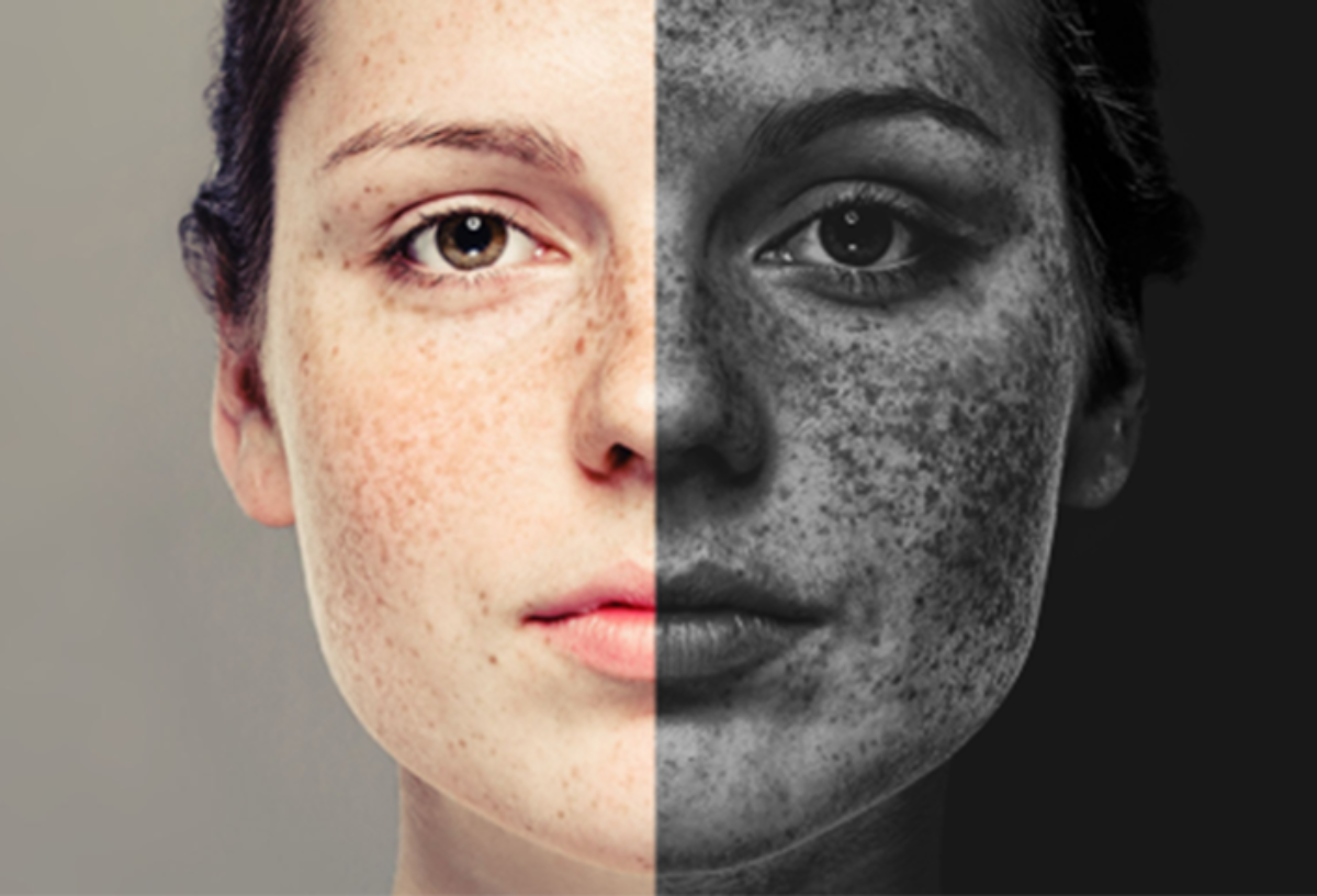 Kell egy rémisztő UV-fotó a bőrödről, hogy végre elkezdd rendesen használni a fényvédőket?