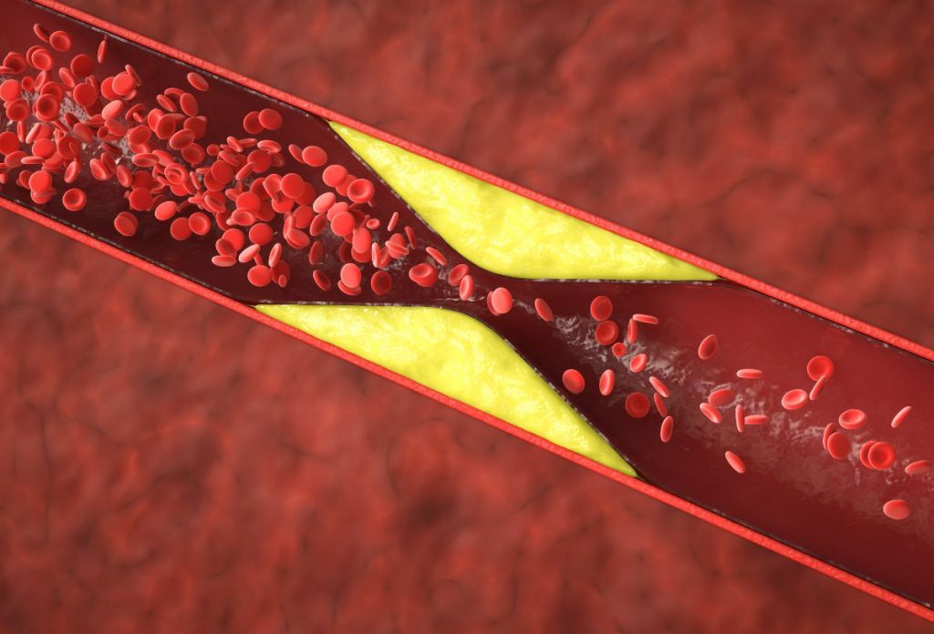 A magas koleszterinszint miatt plakkok tapadhatnak meg az érfalon, ami elzárhatja az ereket