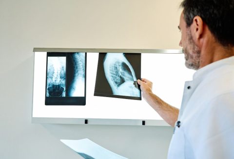 Covid-19 és rák összefüggése