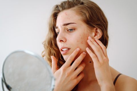 Pattanás elleni tapasz házilag: így készíthetsz otthon