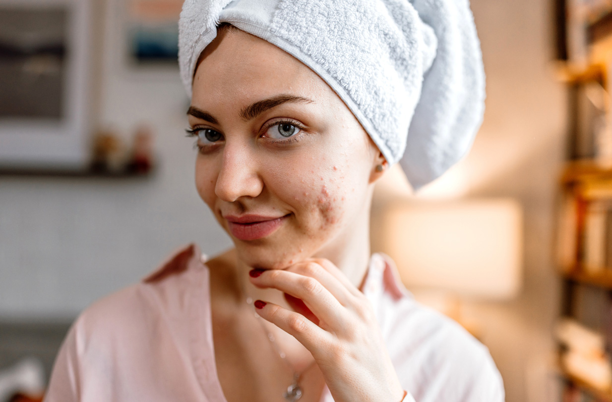 A pattanások és az aknék is arcon utalhatnak különböző betegségekre