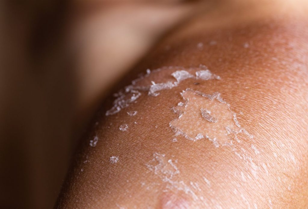 a-legjobb-leeges-utani-kremek | Marie Claire Hámló bőr napégés után