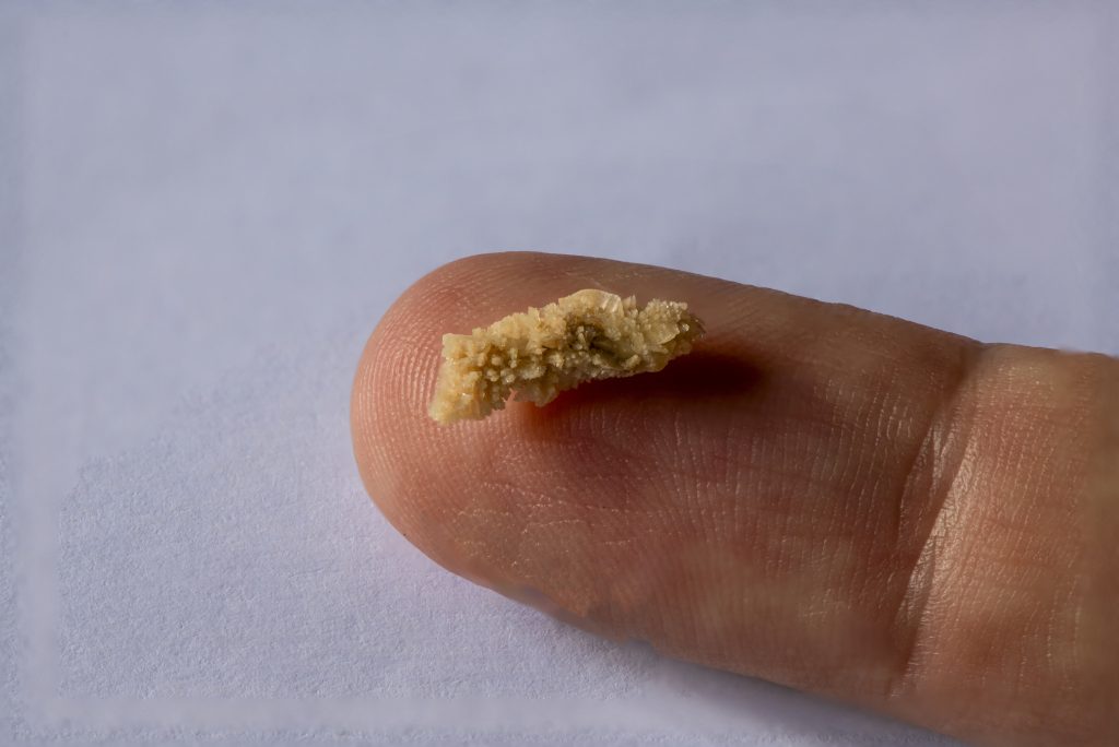 Körülbelül 8 mm-es nagyságú vesekő