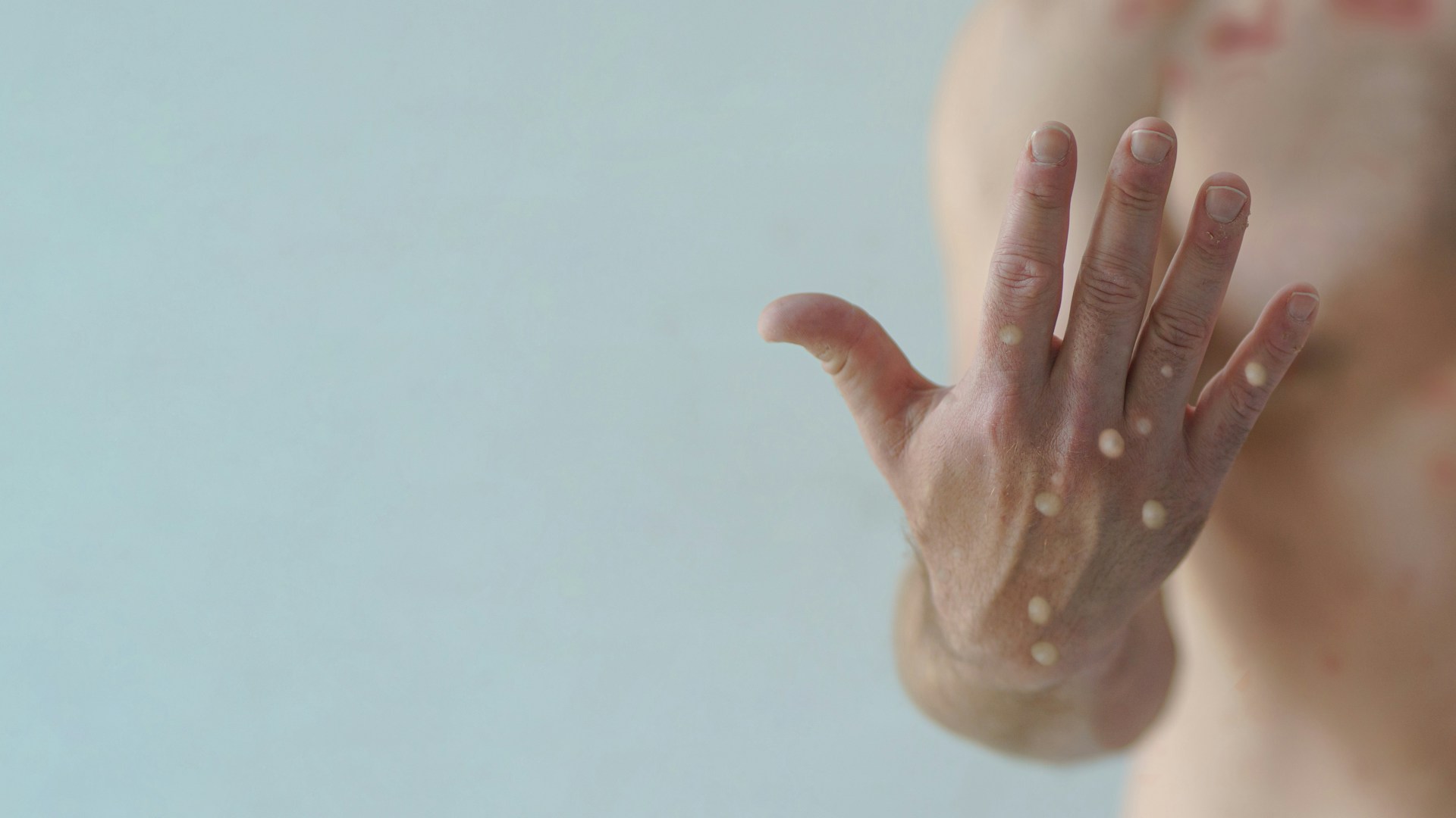 Hólyagok egy kézen