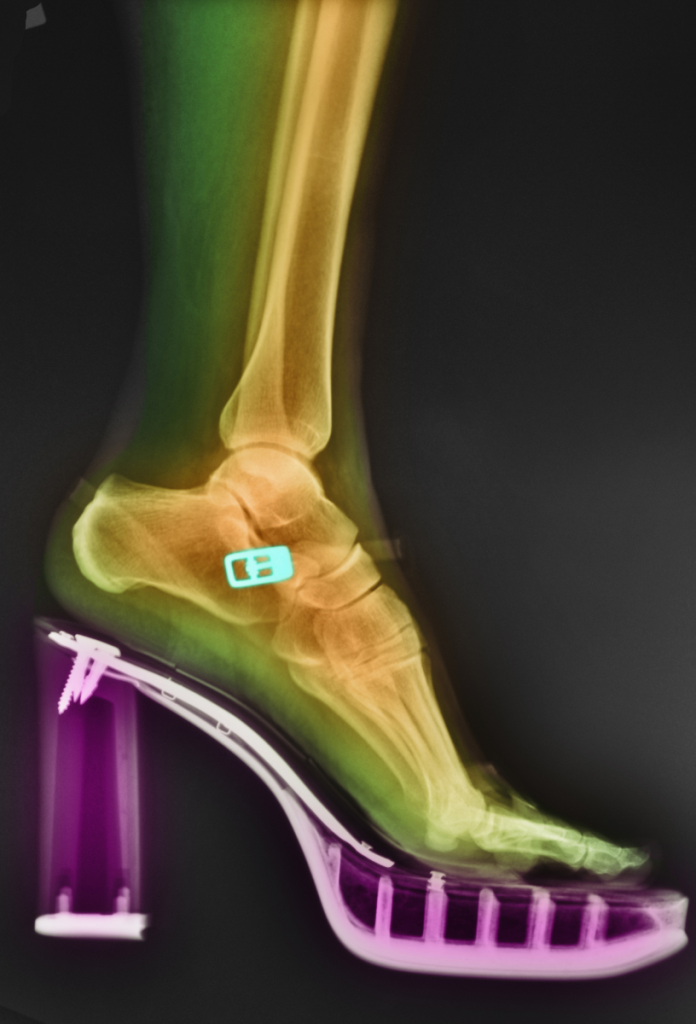 Színezett röntgenkép a lábfej csontjairól magassarkú cipőben