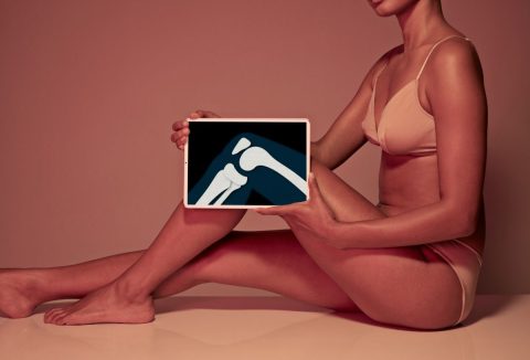 Bronzárnyalatú fotó, egy nő nyaktól lefelé ül alsóneműben, az egyik térdét felhúzza és a térdnél egy tableten az ízület röntgenképét mutatja