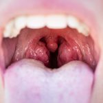 Nyitott száj közelről, látható uvula és mandulák