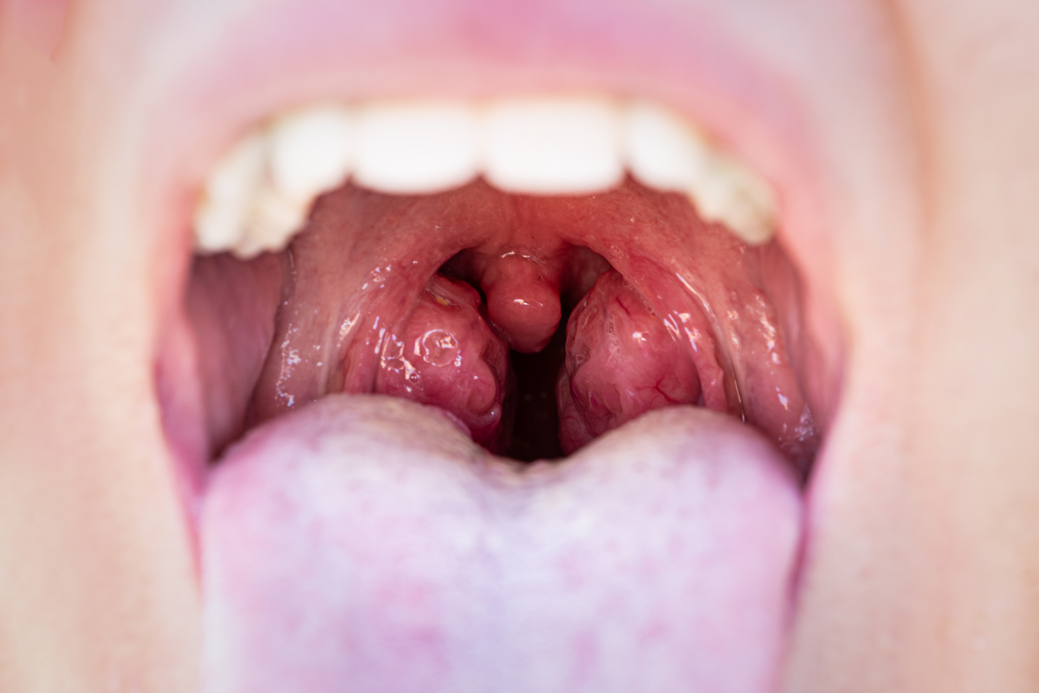 Nyitott száj közelről, látható uvula és mandulák