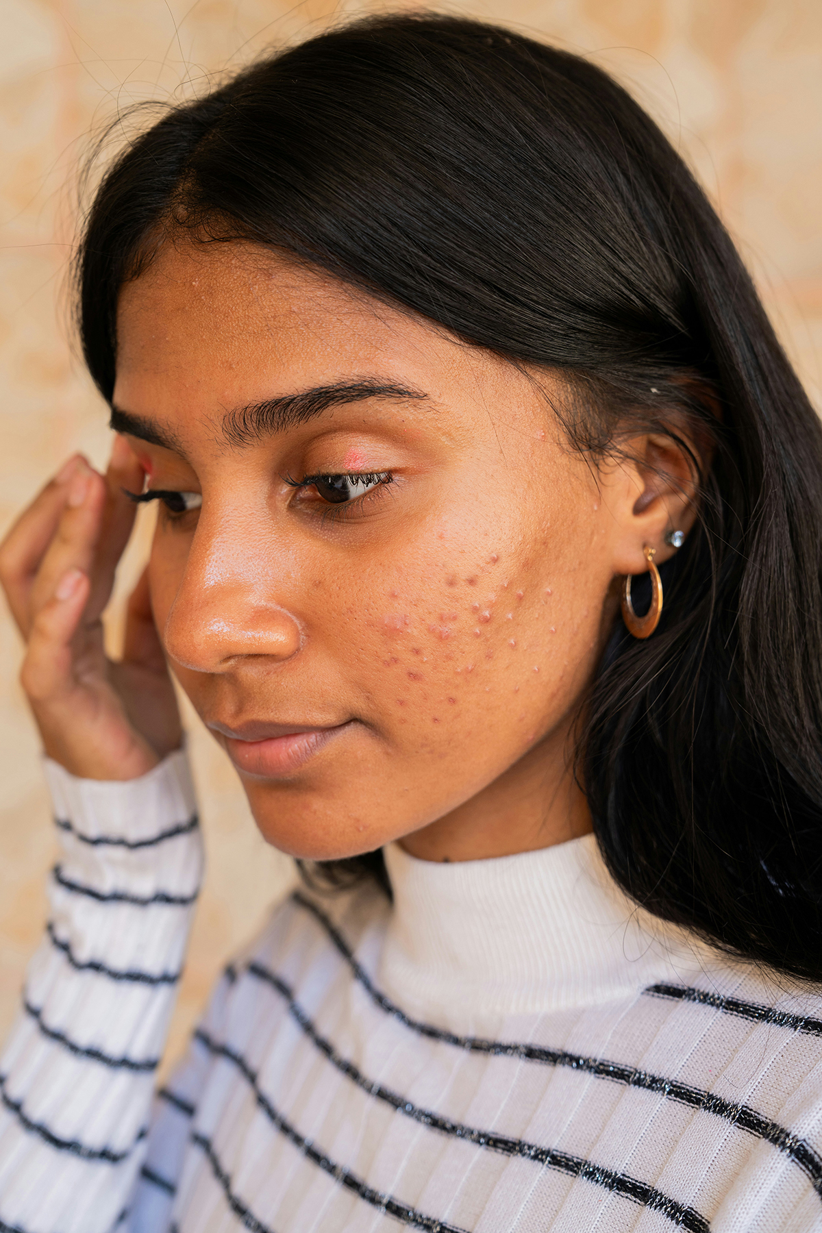 Fiatal lány a pattanásos arccal