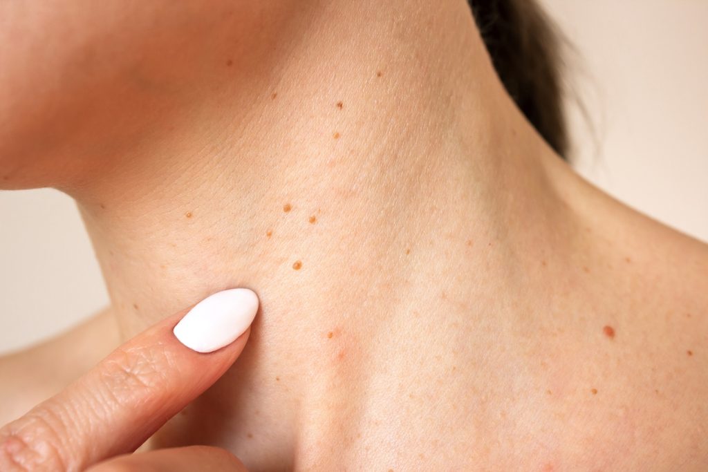 fibroma-eltaviltas-otthon-veszelyei2 | Marie Claire Női nyak, rajta fibrómákkal