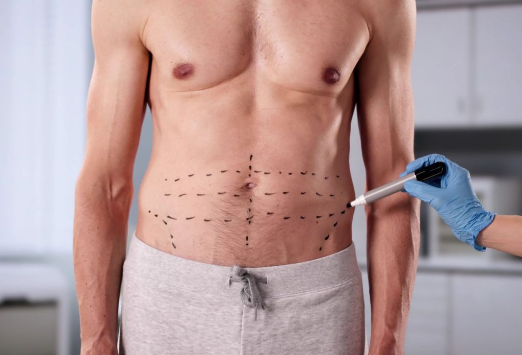 Zsírleszívás és testkontúrozás vonalát jelöli meg edzett férfi testén plasztikai sebész fekete filctollal