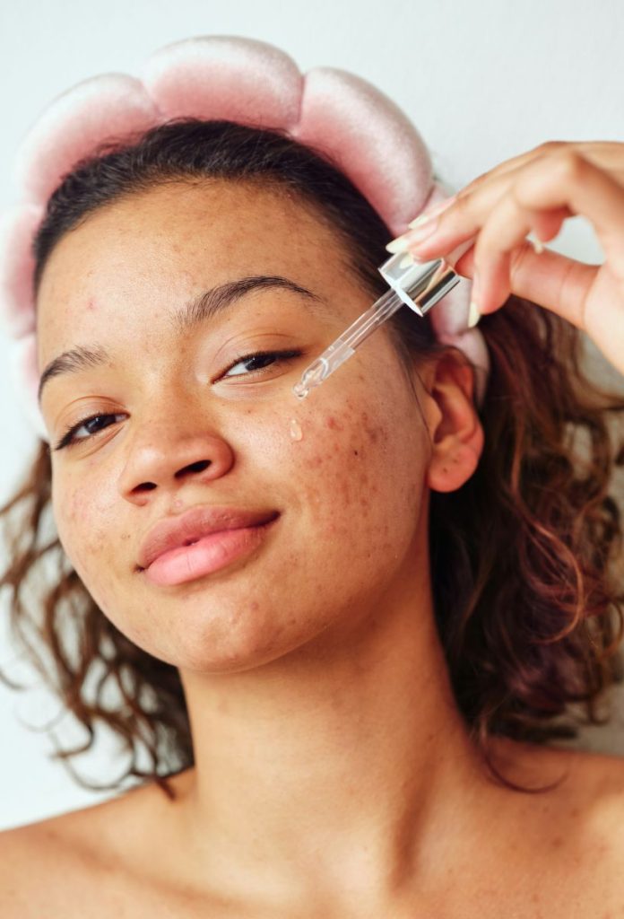 Feketebőrű fiatal nő azelainsav szérumot visz fel aknés bőrre