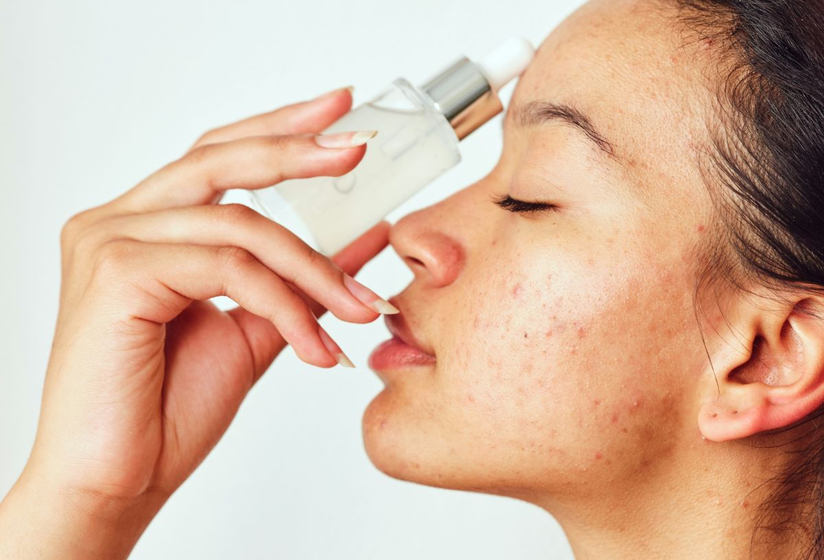 Aknés bőrű nő arca oldalról, azelainsav szérumos üveget tart az orrnyergéhez csukott szemmel