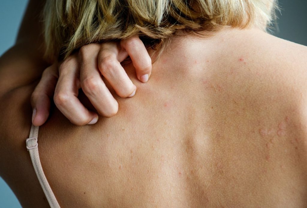 Nő viszkető vállát vakarja közeli képen háttal állva