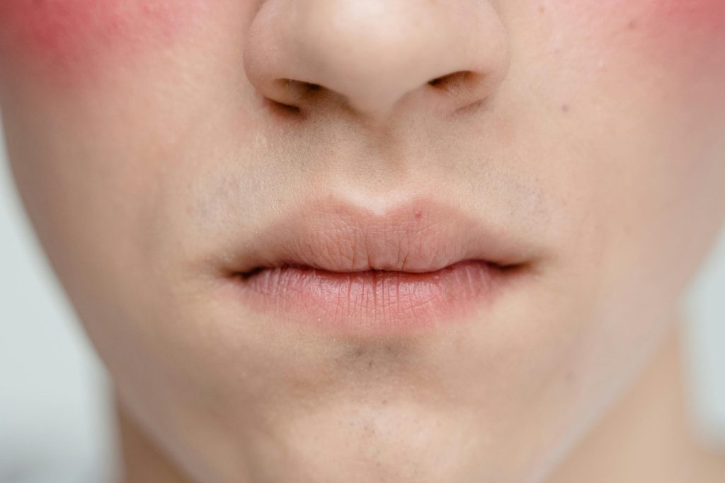 Női arc alsó része, kipirosodott orcákkal, rosacea