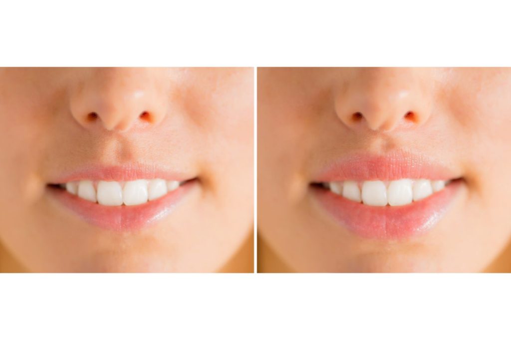 Nő szája liplifting előtt és után