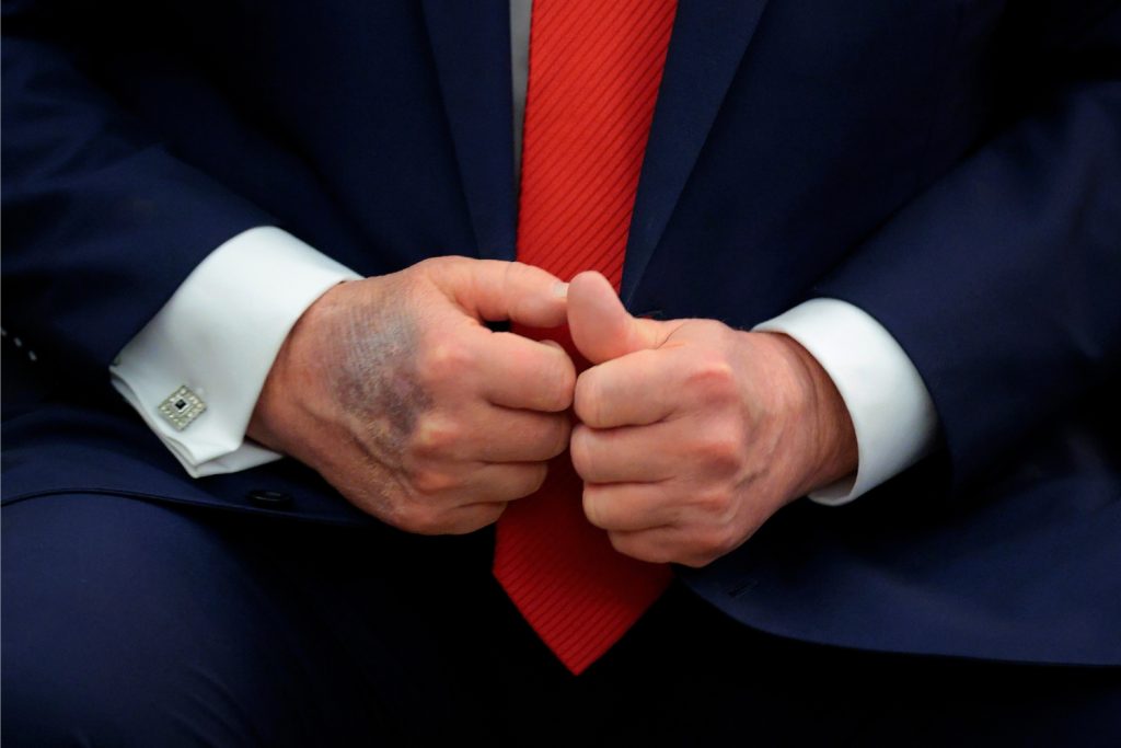 donald-trump-veralafutas | Marie Claire Donald Trump véraláfutásos kezei a dél-koreai elnökkel való találkozása alatt közeli képen